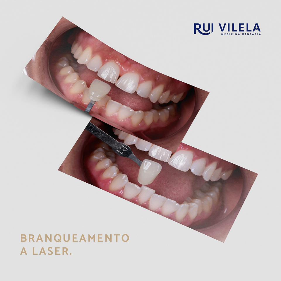 Branqueamento a Laser