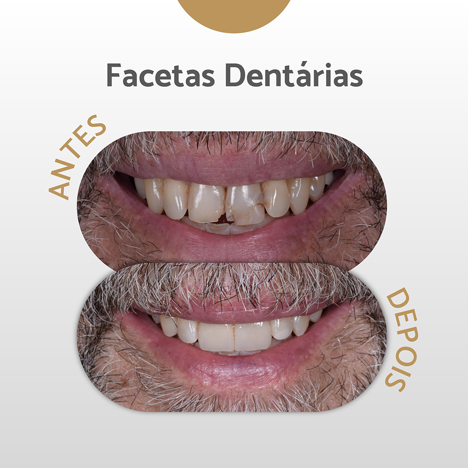 Facetas Dentárias Facetas Dentárias