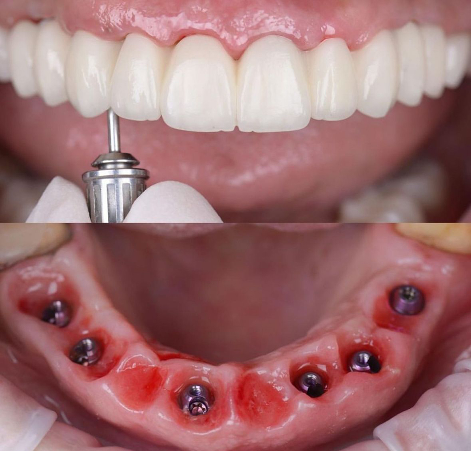 Dentes fixos em um dia! Dentes fixos em um dia!