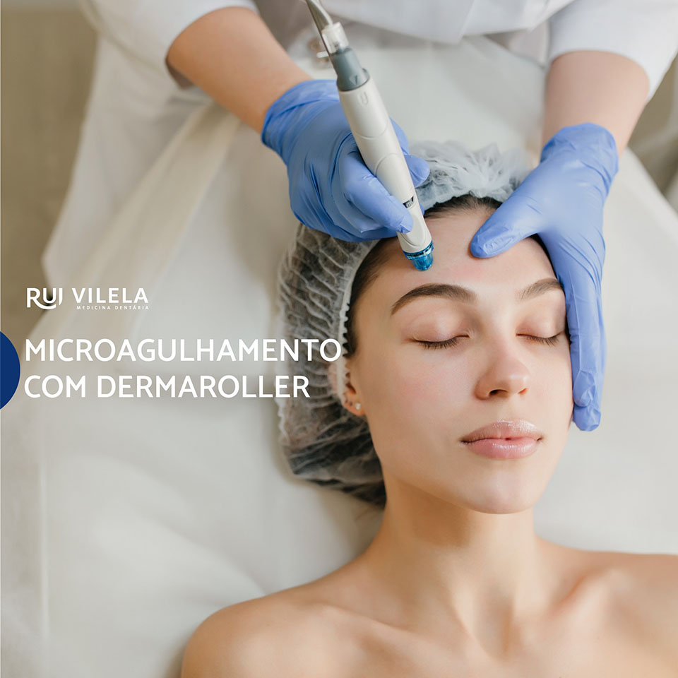 Microagulhamento com Dermaroller