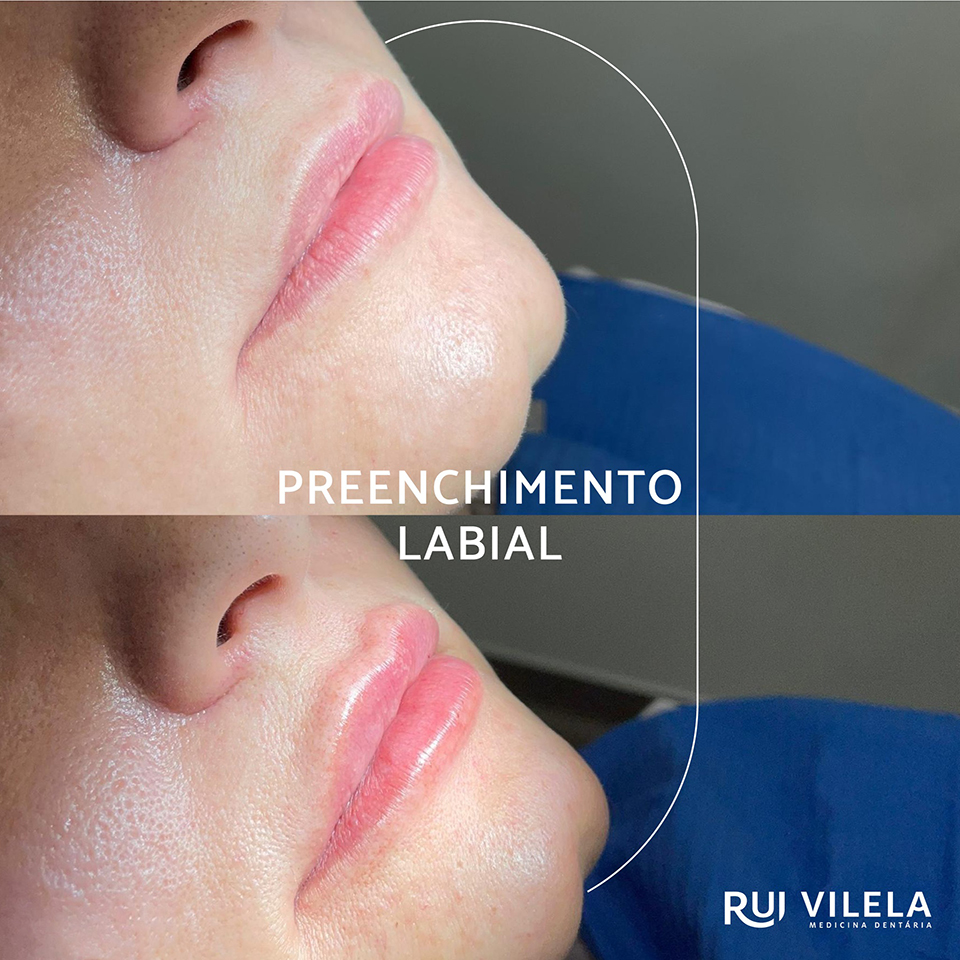 Preenchimento Labial