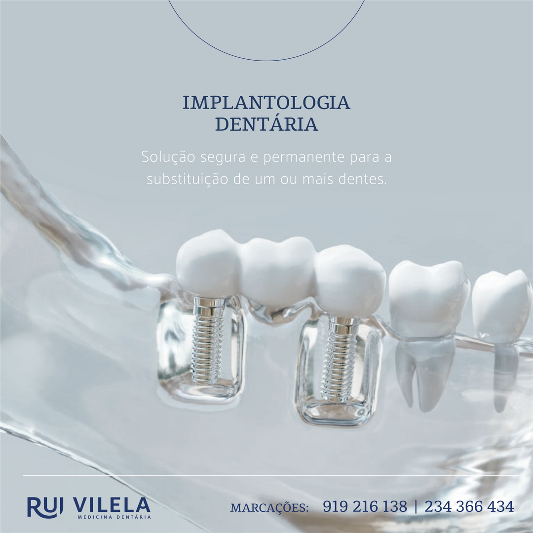 Implantologia Dentária Implantologia Dentária