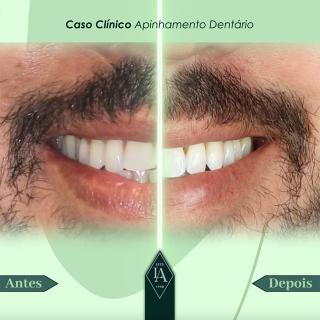 Apinhamento Dentário