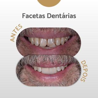 Facetas Dentárias