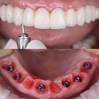 Dentes Fixos em um dia!