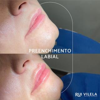 Preenchimento Labial