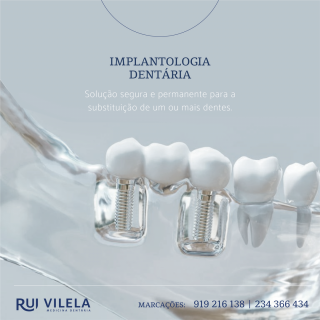 Implantologia Dentária