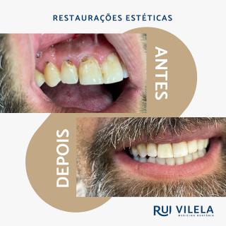 Restaurações Estéticas