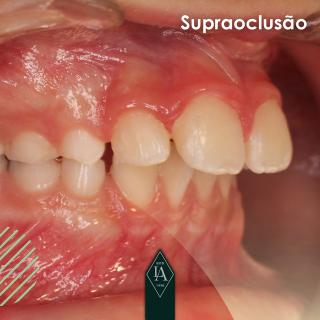 Supraoclusão