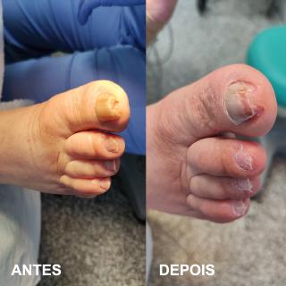 Tratamento unhas e pés