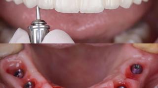 Dentes Fixos em um dia!