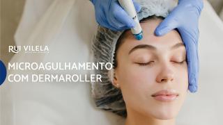Microagulhamento com Dermaroller