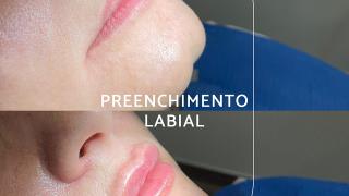 Preenchimento Labial