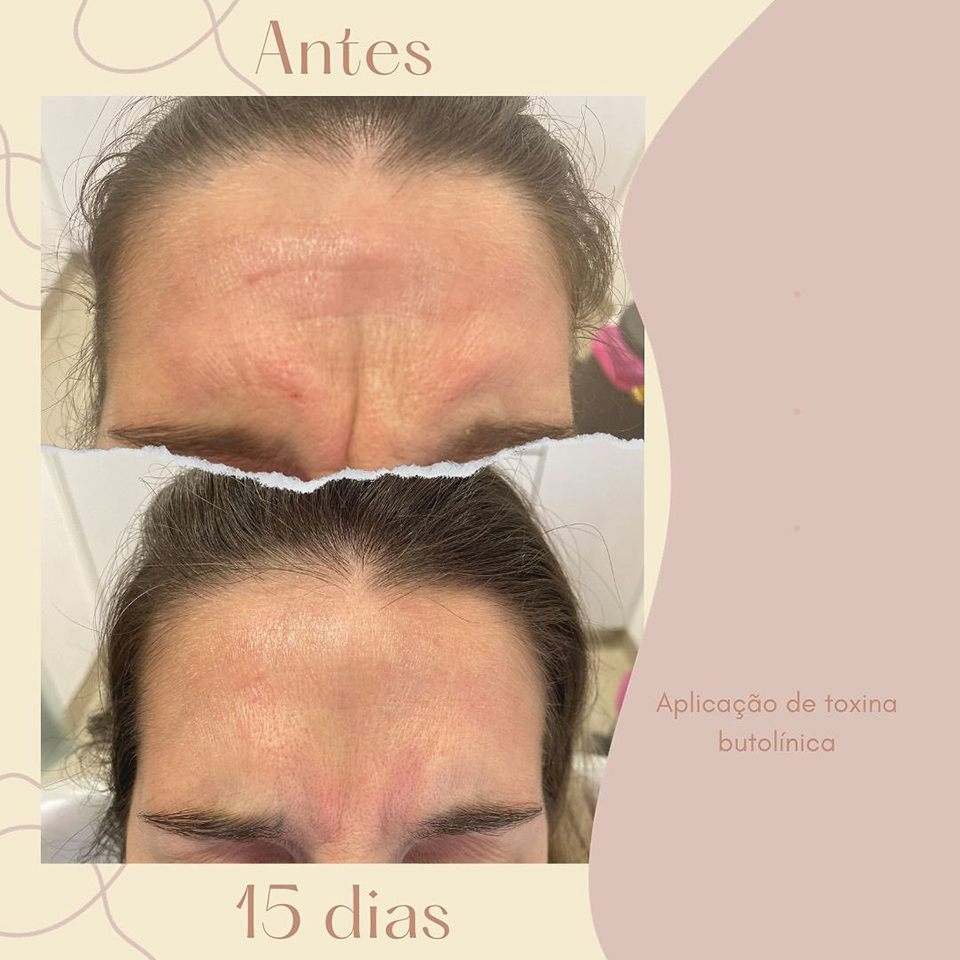 Botox