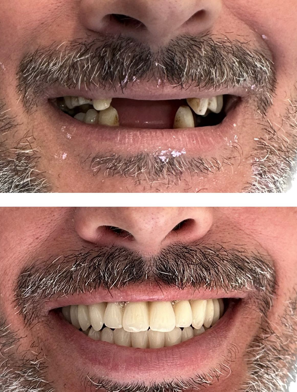 Dentes fixos totais Dentes fixos totais