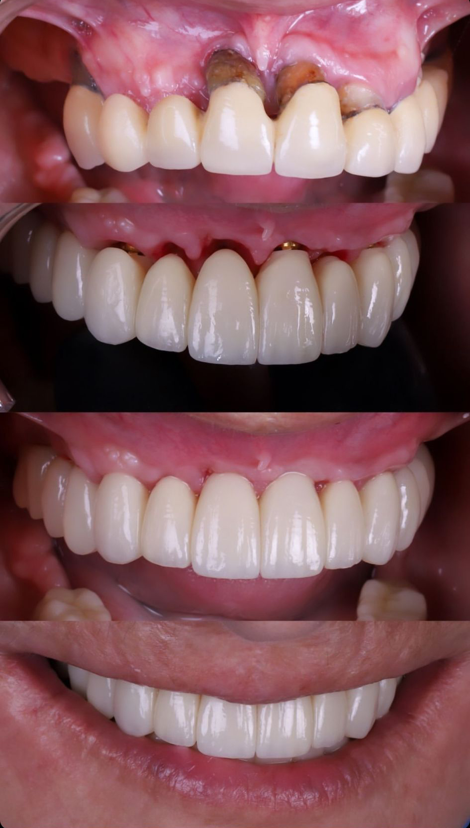 Dentes fixos em um dia! Dentes fixos em um dia!