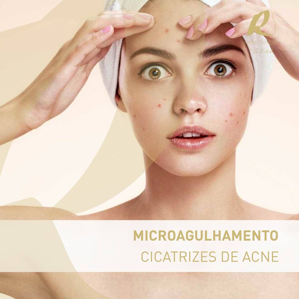 Microagulhamento Microagulhamento